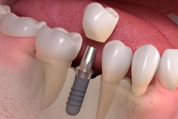 Dental Implant Treatment in Kozhencherry