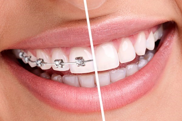 Orthodontic Treatment in Kozhencherry